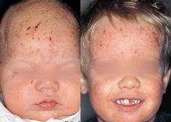 Dermatitis Atopica | Patologias Dermatologicas